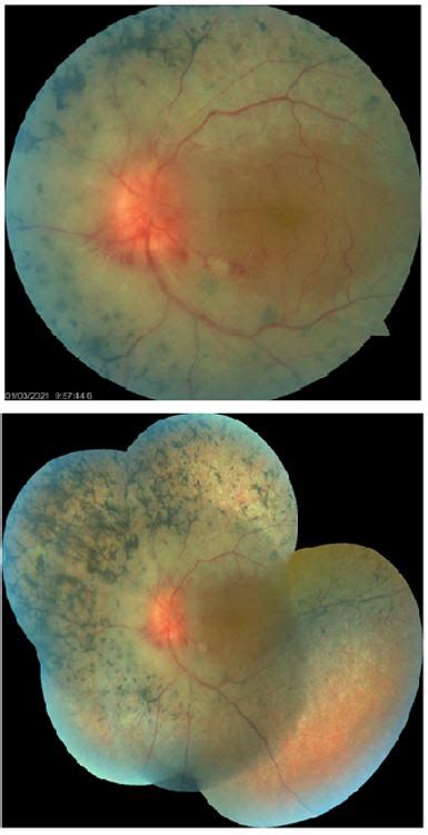 JCM V3 1545 Successful Treatment Of Cystoid Macular Edema In Central