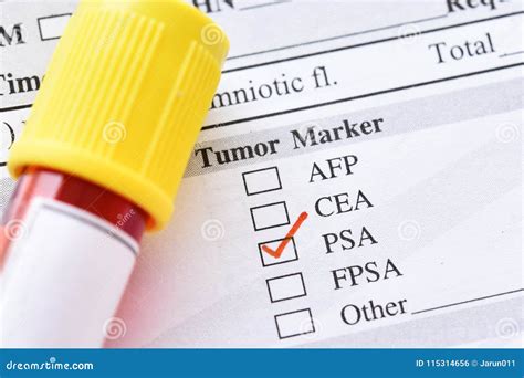 Blood Sample For PSA Test Stock Photo Image Of Health 115314656