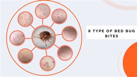 Wolf Spider Bite: Stages and Symptoms with Pictures