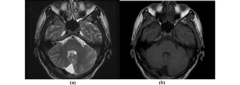 Axial T2-(a) and T1-weighted (b) sections of MRI brain show decreased ...