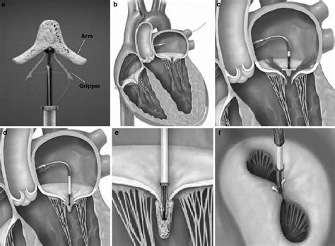 A MitraClip Device With Two Movable Arms And Grippers B Guide Catheter