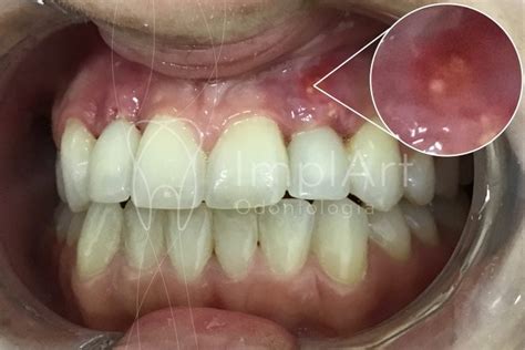 F Stula Dental Saiba Mais Sobre Essa Condi O Na Gengiva