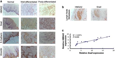 Overexpression Of Hmga2 Promote Tscc Epithelialmesenchymal Transition