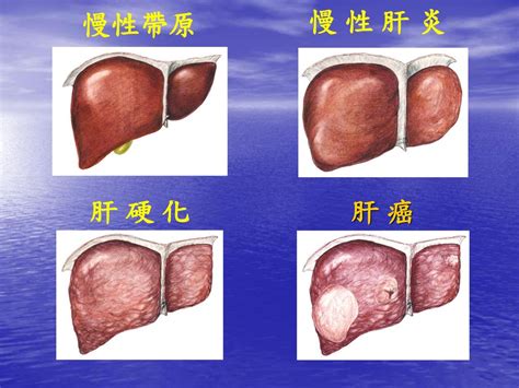 肝癌 期中報告 指導老師 顏嘉宏 Ppt Download