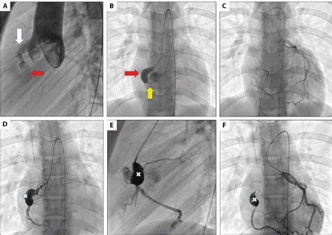 Congenital Coronary Aneurysm And Cameral Fistula Embolization In A