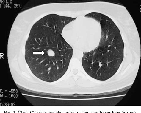 Figure 1 From Salivary Gland Type Mixed Tumor Pleomorphic Adenoma Of