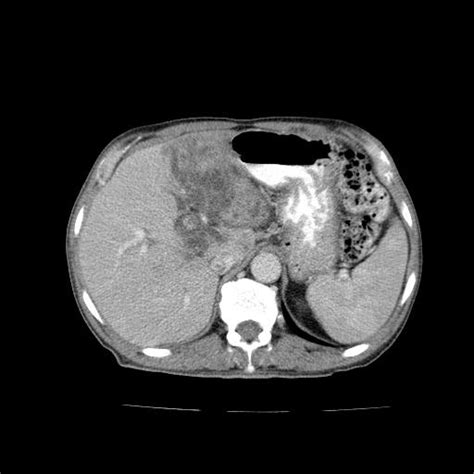 Klatskin Tumor Hilar Cholangiocarcinoma Image Radiopaedia Org