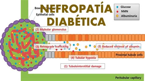 Enfermedad Renal Diab Tica Fisiopatolog A Diagn Stico Tratamiento