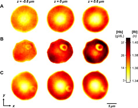 Three Dimensional Refractive Index Maps Of Uninfected Rbcs And Ring