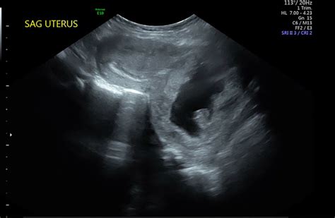 9 Week Ectopic Pregnancy Ultrasound