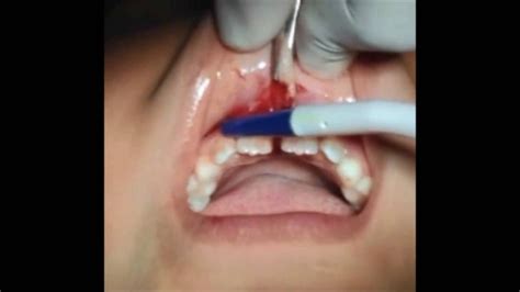 Cirug A De Frenectomia Labial Paso A Paso Frenectomy Labial Diastema