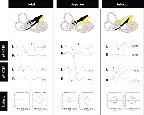 Vestibular Evoked Myogenic Potential Vemp Findings In Acute Download Scientific Diagram