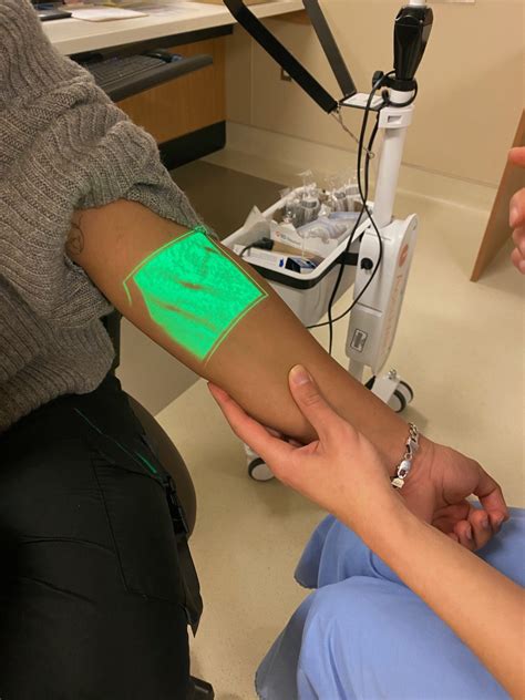 AccuVein Vein Finder Illuminates Veins Aiding IV Insertion