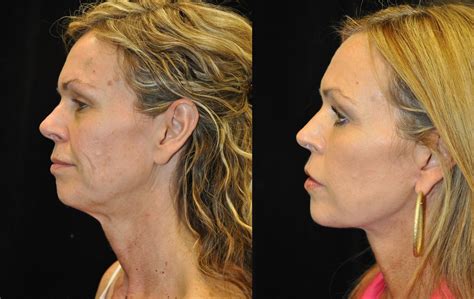 Facial Fat Grafting Before After Photos Facelift Beverly Hills