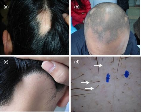 How To Stop Alopecia Areata From Spreading