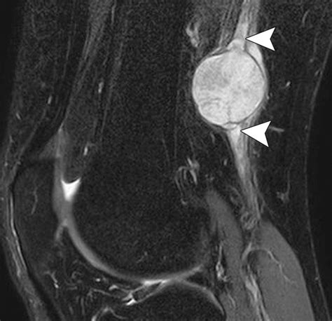 Mr Imaging In The Evaluation Of Cystic Appearing Soft Tissue Masses Of