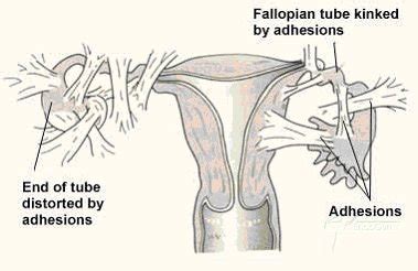 Symptoms of adhesions » Adhesions