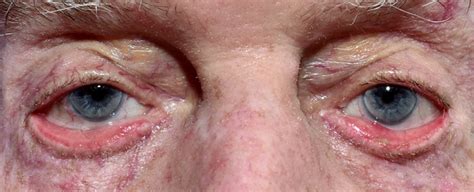 Eye Conditions And Diseases