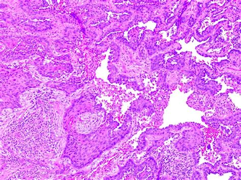 Pathology Outlines Adenosquamous