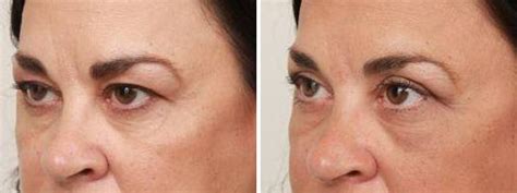 Eyelid Lift Philadelphia Blepharoplasty Dr Chapin