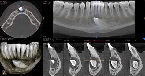 Tomografia stożkowa CBCT tomografia szczęki Białystok tomografia