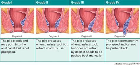 Foods To Help Ease Piles Haemorrhoids And Ibs Smiles No Piles