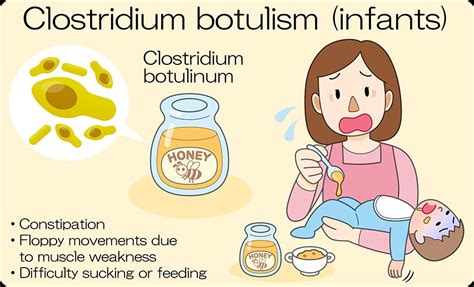 Botulism The Silent Threat Types Causes Symptoms And Treatment