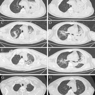 Serial Chest Computed Tomography CT Scans Of A 49 Year Old Woman With