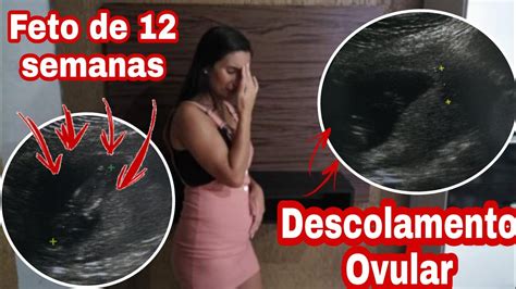 O Que Descolamento Ovular Braincp