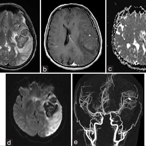 A E Axial T2wi And Dwi Shows Large Left Sided Intraparenchymal Hematoma