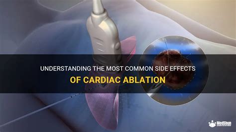 Understanding The Most Common Side Effects Of Cardiac Ablation | MedShun