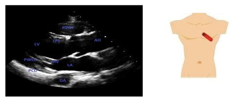 Parasternal Long Axis View Plax Rcemlearning