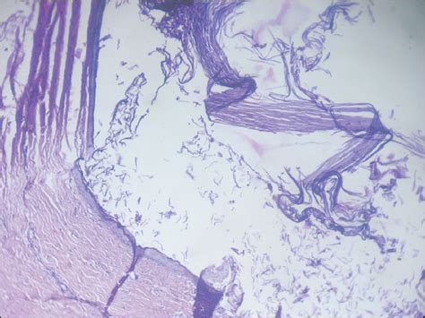 Cytodiagnosis Of Epidermoid Cyst Of The Upper Lip A Common Lesion In