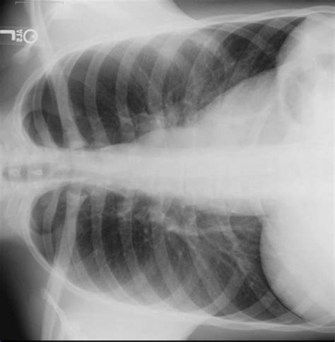 Best Of: Finding Rib Fractures On Chest X-Ray | The Trauma Pro