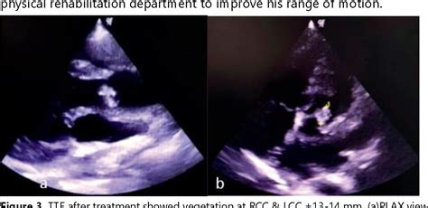 Figure 1 From Embolization Of Infective Endocarditis Vegetation Causes Intracranial Hemorrhage