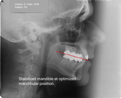 Occlusion Connections Blog What Angle Is The Occlusal Plane Relative