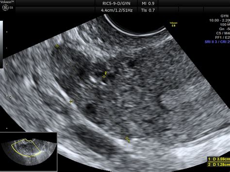 Niedoceniana Rola Usg W Diagnostyce Endometriozy Esterclinic