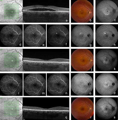 Multimodal Imaging Of A Year Old Male With Chronic Central Serous