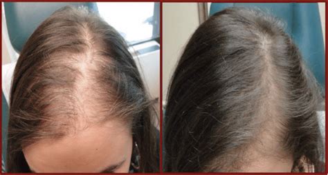 Platelet-Rich Plasma (PRP) For Hair Growth