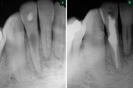 Root Resorption