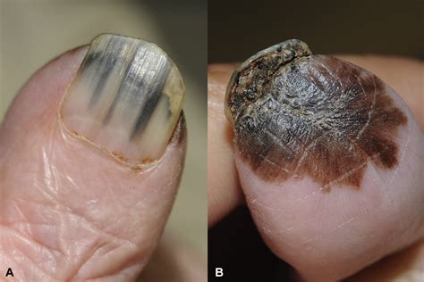 Acral Melanoma Mimicking Subungual Hematoma Journal Of The American