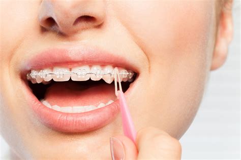 Tipos de gomas para ortodoncia Gramadent Clínica Dental