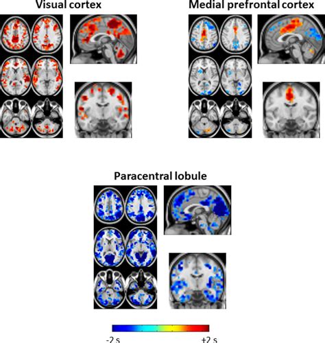 Mri Paracentral Lobule