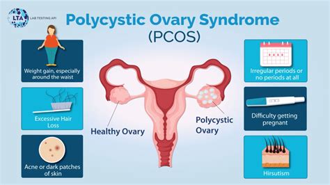 Polycystic Ovary Syndrome PCOS Test Package For Women Awami Lab