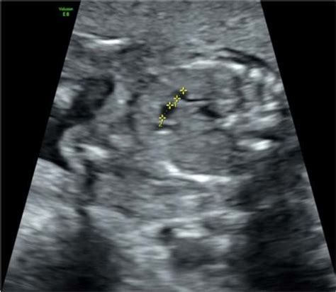 Three vessel view shows that a diameter of ascending aorta larger than ...