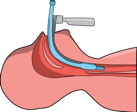 A Hand Drawn Illustration Of A Medical Endotracheal Intubation 27560540