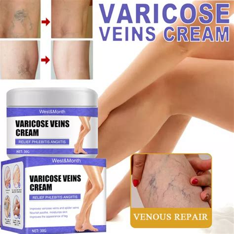 Veine Soin D Coloration Cr Me Varices Pour Jambes Herbes Pommade Chaud