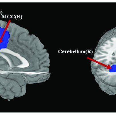 Regions Showing Reduced Gray Matter Volume In Pure Non Comorbid AN