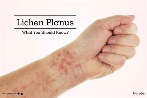 Oral Lichen Planus Symptoms