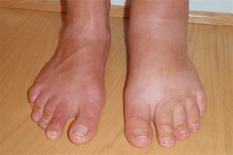 Lower Extremity Edema Causes Treatment And Prevention